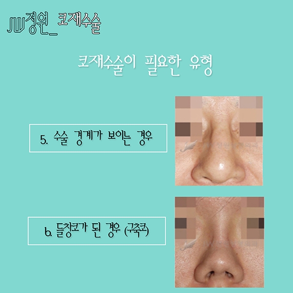 Nose revision surgery is definitely at JW Jeongwon Plastic Surgery! image 7
