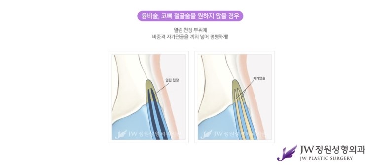 [JW정원성형외과] 매부리코성형, 매부리코성형 잘하는 곳에서 고민해결! 관련 이미지 6