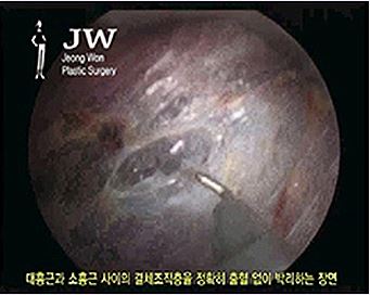 내트렐 510, JW정원성형외과에서 만나보세요! (앨러간) 관련 이미지 5