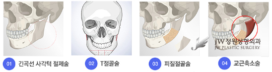강한 인상을 부드럽게 바꾸는 브이라인성형 관련 이미지 1