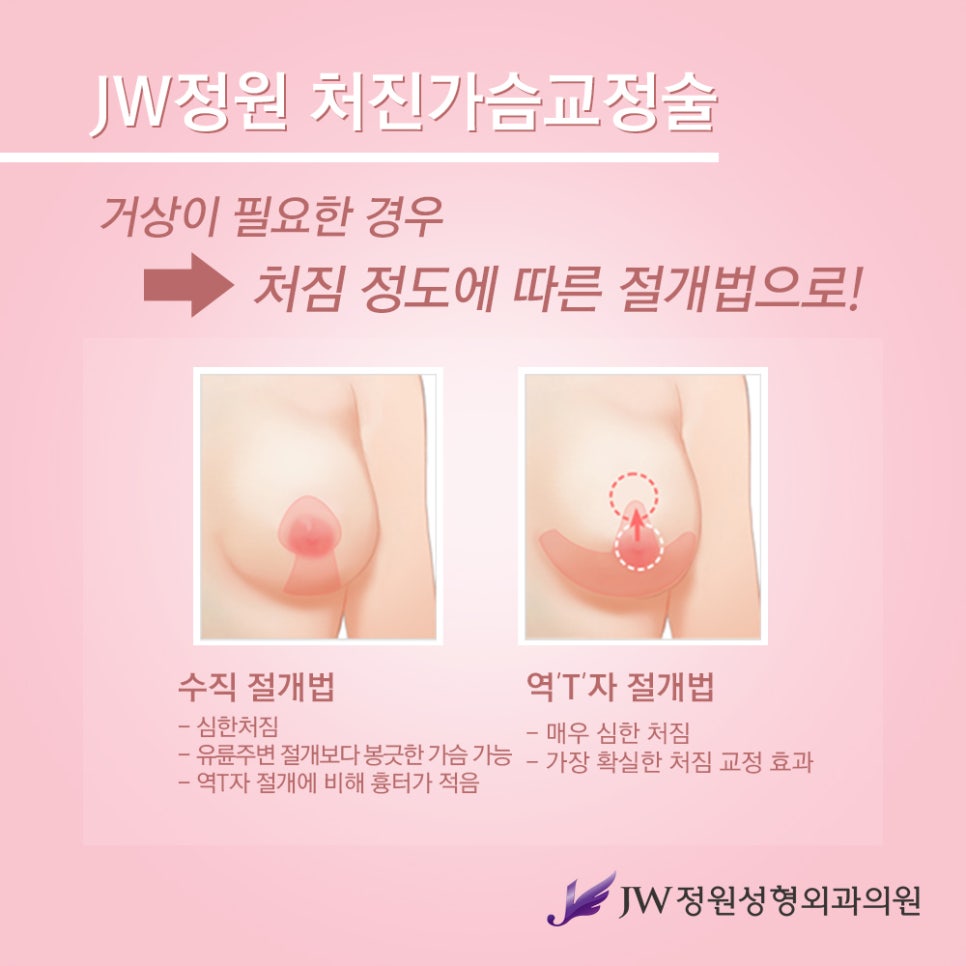 [JW정원성형외과] 처진가슴교정으로 자신감 회복! 관련 이미지 7