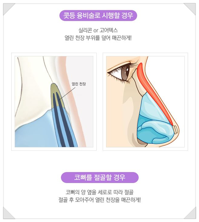 Creating a Soft Line with Hump Nose Correction for a Prominent Bridge and Drooping Tip image 5