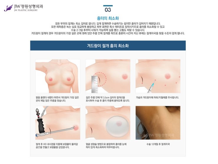 [JW정원성형외과] 가슴보형물 + 가슴지방이식 장점을 담은 콤비네이션 가슴확대성형 관련 이미지 8