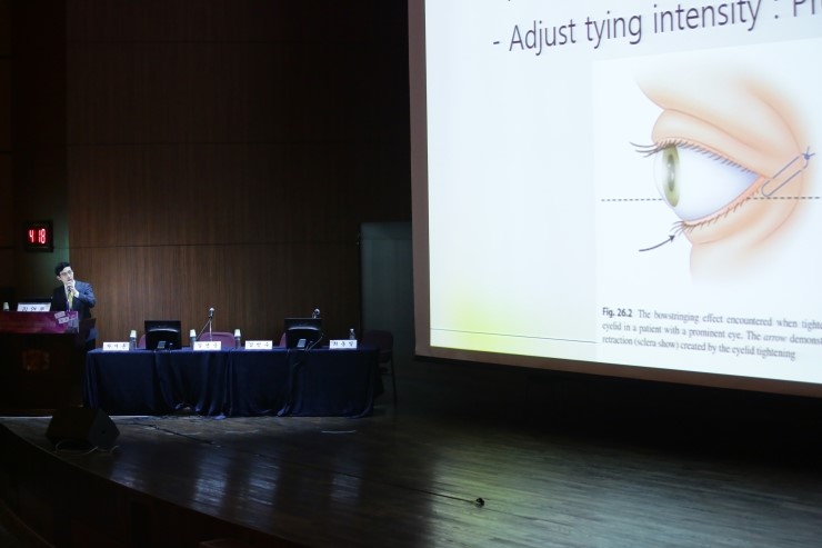 김연준 원장의 뒤트임수술 노하우▷JW정원성형외과 듀얼트임 관련 이미지 4