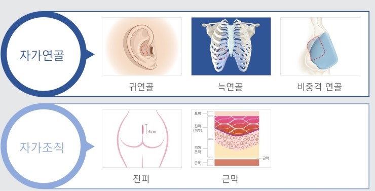 자연스럽고 오뚝한 코, JW정원성형외과 낮은코성형 관련 이미지 5