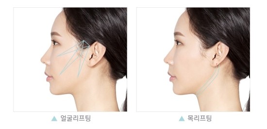 탄성밴드로 완성하는 동안얼굴! JW정원 엘라스티꿈 리프팅 관련 이미지 5