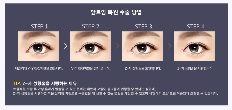 트임 재수술, 복원수술도 역시 JW정원성형외과! 관련 이미지 4