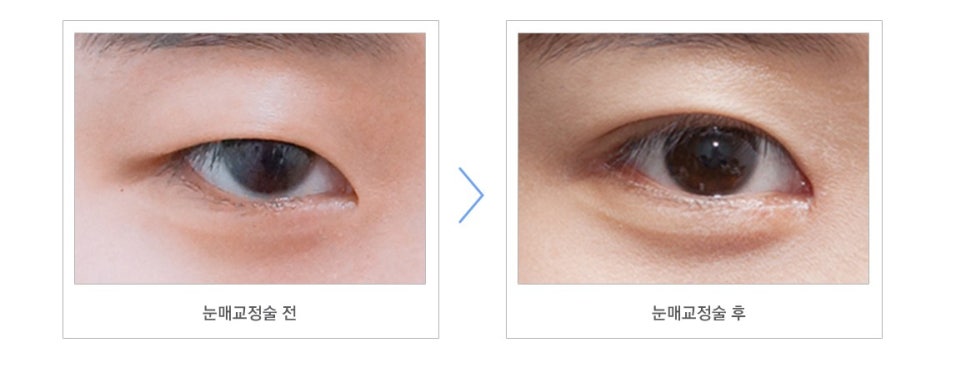 Ptosis Double Eyelid Surgery: Different Eye-Correction Methods Depending on the Degree image 1