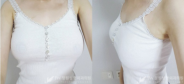비대칭, 처진가슴 교정도 역시 JW정원성형외과에서! 관련 이미지 5