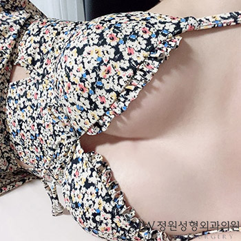 Breast Lift Surgery for Drooping Breasts, with a Natural and Firm Result image 1