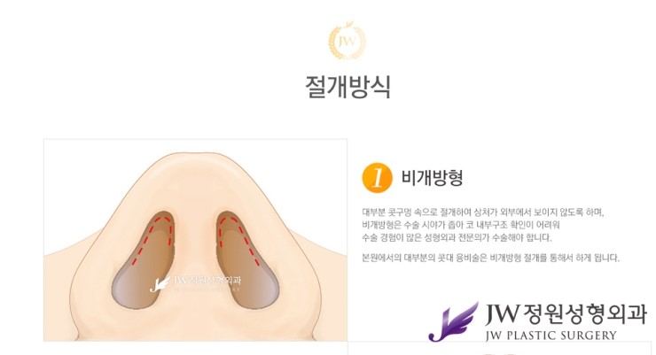[JW정원성형외과] 낮은코를 개선해주는 낮은코성형 알아봐요! 관련 이미지 3
