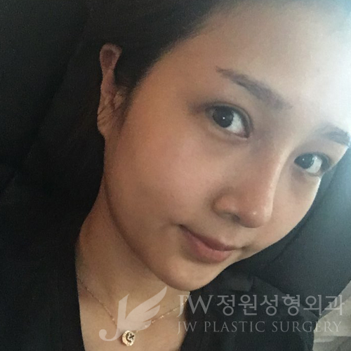 JW정원성형외과에서 매몰쌍꺼풀,앞트임,듀얼트임,코성형,넥리프팅으로 여신효과♡ 관련 이미지 7