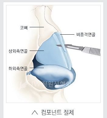 Hump Nose Correction for a Smooth Line Without Recurrence image 4