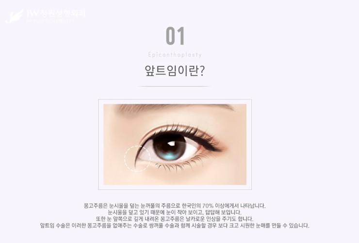 [JW정원성형외과] 시원한 눈매를 완성해주는 트임성형, 트임성형 잘하는 곳에서! 관련 이미지 3