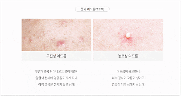 석촌역 여드름 피부과 진료 치료 방법과 종류는? 관련 이미지 3