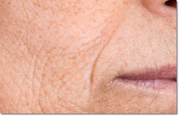 If You’re Curious About the Principles and Effects of Viro Ultrasound and Radiofrequency Lifting image 4