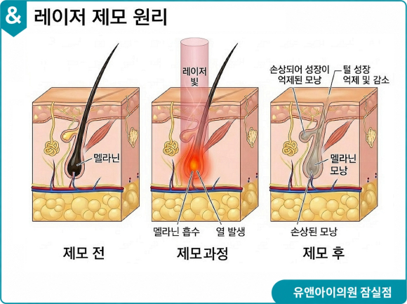 잠실 남자 제모, 효과와 통증 정도는? 관련 이미지 2