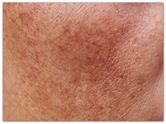How much can Jamsil Pico Toning help remove melasma, age spots, freckles, and lentigines? image 2