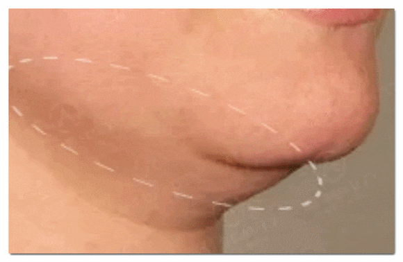 If You’re 고민ing About Double Chin Lifting with Jamsil InMode image 2