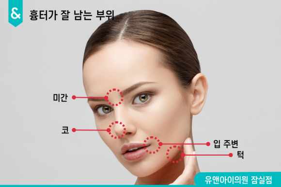 잠실점제거 빼기 전, 꼭 확인해야 하는 3가지 관련 이미지 4