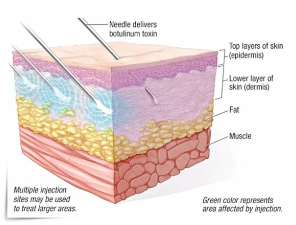 What Is the Difference Between Skin Botox and Rejuran? Can They Be Done Together? image 3