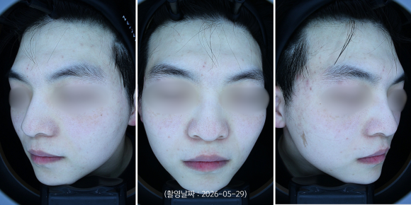 Jamsil Acne Dermatology Clinic: A Case of Treating Acne Pigmentation Scars image 6