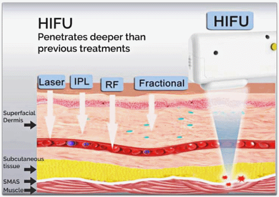 If You Were Afraid of the Pain and Couldn’t Get Ultherapy Near Seokchon Station, What Then? image 2