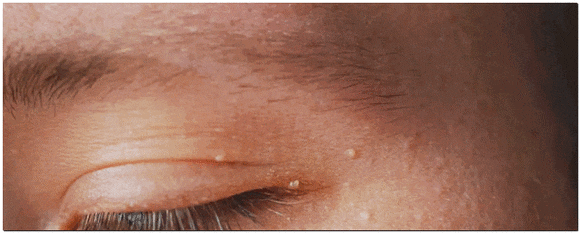 How to Tell if It’s Milia in Jamsil? What If It Spreads or Gets Bigger? image 4