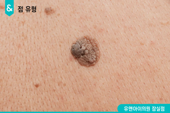 잠실점제거 빼기 전, 꼭 확인해야 하는 3가지 관련 이미지 3