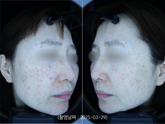 잠실 피코토닝 10회 치료 효과는? 관련 이미지 2