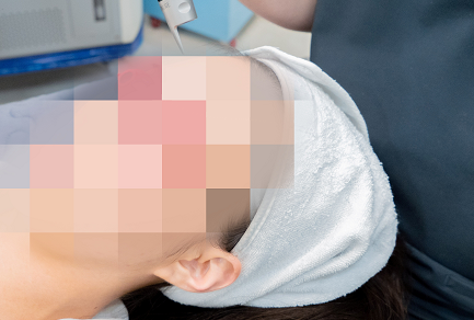 잠실피코토닝, 색소가 더 진해질까 걱정된다면? 관련 이미지 4