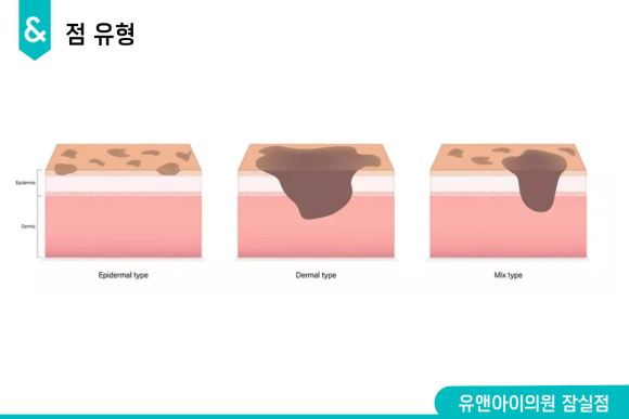 잠실점제거 빼기 전, 꼭 확인해야 하는 3가지 관련 이미지 2