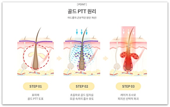 Seokchon Station Dermatology Treatment: What Are the Methods for Pore Elasticity and Sebum Control? image 7