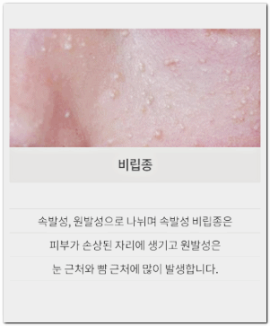 How to Tell if It’s Milia in Jamsil? What If It Spreads or Gets Bigger? image 2