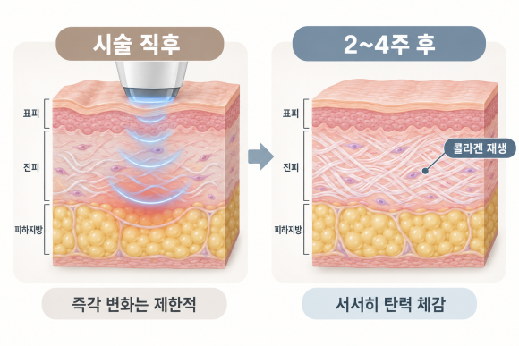 송파구온다리프팅 원리부터 효과·유지기간, 부작용까지 알아보기 관련 이미지 4