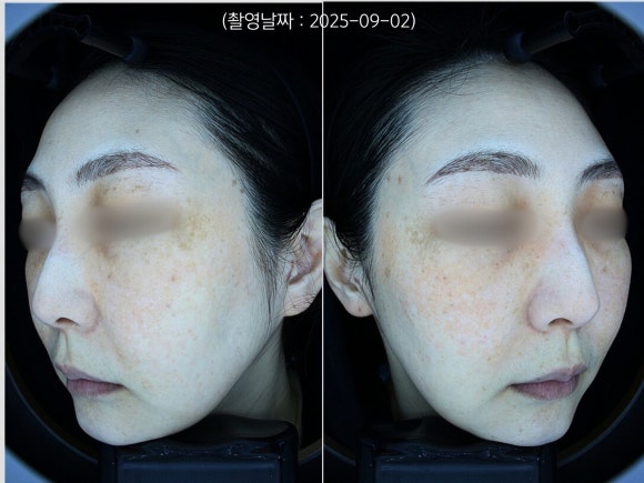 Jamsil Laser Toning: A Case of Treating Dark Spots Around the Eyes and Facial Redness image 1