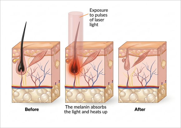 Jamsil Underarm Hair Removal: Most People Don’t Know This, So They Don’t See Results image 2