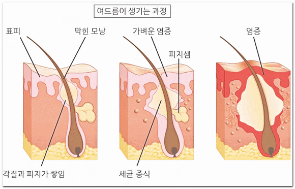 석촌역 여드름 피부과 진료 치료 방법과 종류는? 관련 이미지 2
