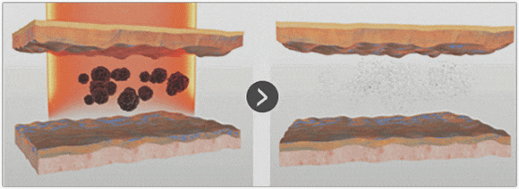 Jamsil PicoSure: If you’re worried about skin pigmentation issues like melasma and dark spots image 6