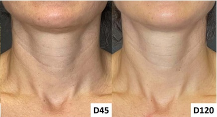 How much can Radiesse help with neck wrinkles? image 9