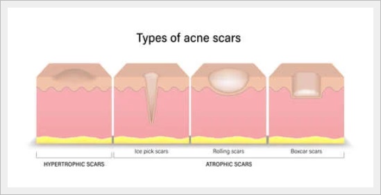 Jamsil Acne Scars: Can Depressed Marks Really Become Less Noticeable? image 9