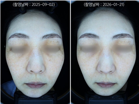 Jamsil Laser Toning: A Case of Treating Dark Spots Around the Eyes and Facial Redness image 6