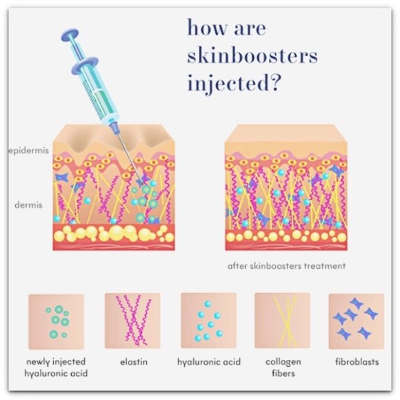 Men’s Skin Booster Injection: Is There a Reason to Get It Even If It’s Inconvenient? image 3