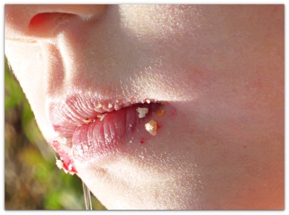Lip Rejuran: Why Is It a Good Fit for People with Lots of Flaking? <Includes How to Reduce Lip Rejuran Pain> image 3