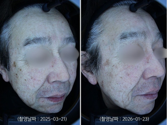 잠실레이저토닝 기미, 잡티, 검버섯 10회 치료 사례 관련 이미지 8