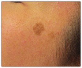How much can Jamsil Pico Toning help remove melasma, age spots, freckles, and lentigines? image 8