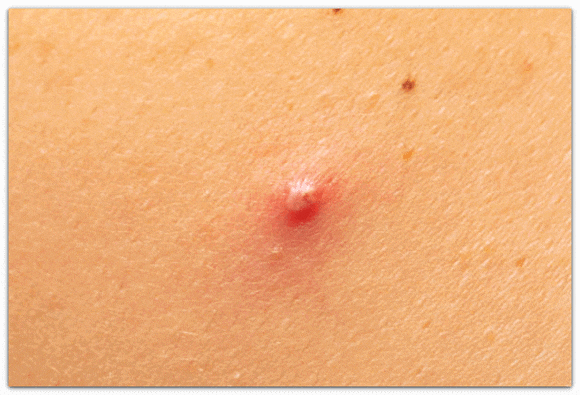 Seokchon Station Acne Dermatology Consultation, Symptoms, and Scar Type Classification: A Complete Summary image 3