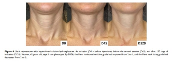 How much can Radiesse help with neck wrinkles? image 6