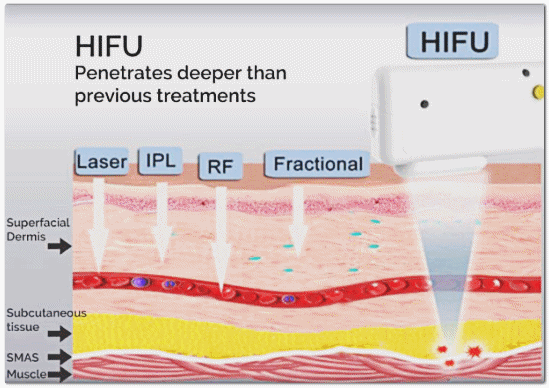 Songpa Lifting: Is There a Factor That Determines the Right Lifting Treatment for Me? image 6