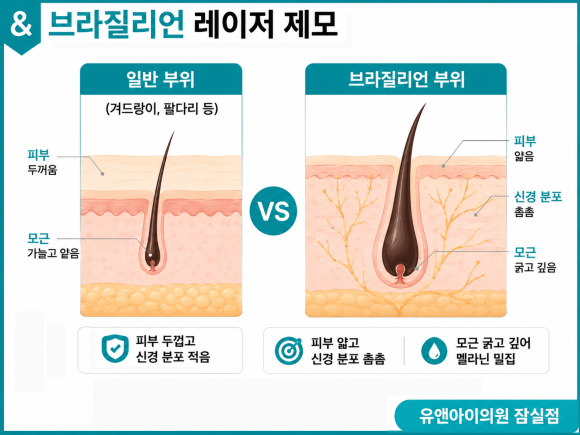 잠실 레이저제모 브라질리언 효과, 통증, 주의사항은? 관련 이미지 3